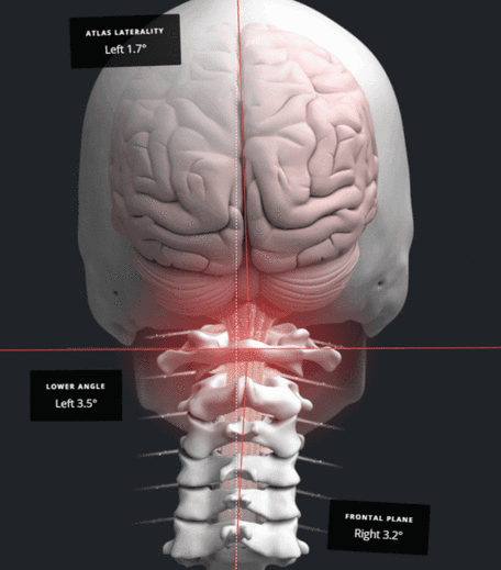 NUCCA analysis showing a craniocervical misalignment (atlas laterality and lower-angle measurements) and its effect on the brainstem