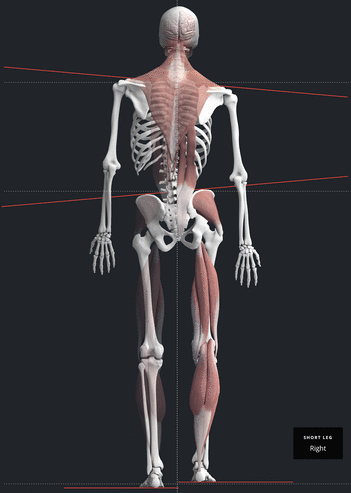 NUCCA full-body postural analysis showing how a craniocervical misalignment can affect the whole body