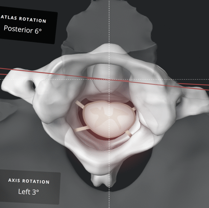 Top-down 3D render of an atlas vertebra showing rotation measurements